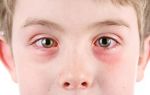 Дексаметазон детям: инструкция по применению и дозировка глазных капель