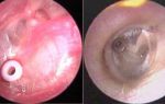 Жидкость в ухе за барабанной перепонкой: лечение и клиническая картина заболевания