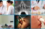 Виды операций носовой перегородки: разновидности септопластики
