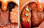 Грибковая ангина: симптомы, лечение, диагностика и отличия от других видов заболевания