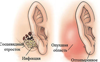 Появилась шишка за ухом: причины и лечение. факторы риска.