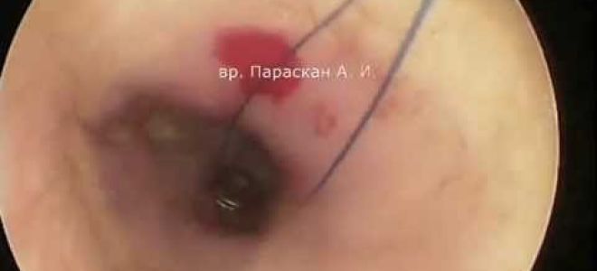 Шунтирование барабанной перепонки уха у детей и взрослых: принцип проведения процедуры