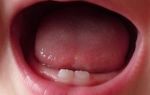 Кашель при прорезывании зубов у детей: причины появления, продолжительность симптома, народные методы облегчения состояния