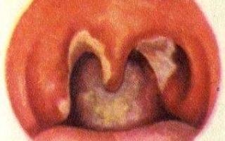 Причины появления спазмов и удушья в горле: основные симптомы
