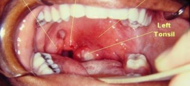 Заглоточный абсцесс: фото, симптомы и лечение у взрослых и детей