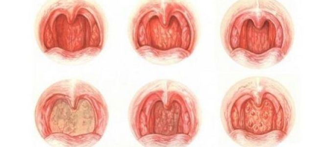 Воспалительные заболевания глотки: симптомы и лечение патологий