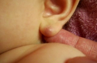 Мочка уха зачем нужна, объяснение генетиков, деформации ушей