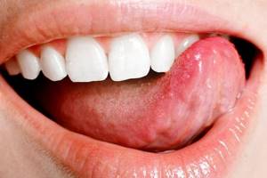 Как проявляются полипы на языке, ближе к горлу или под языком