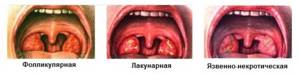 Ангина с язвами во рту - причины появления, диагностика и лечение