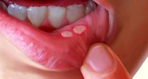 Хлорофиллипт при стоматите - как разводить для полоскания рта и десен