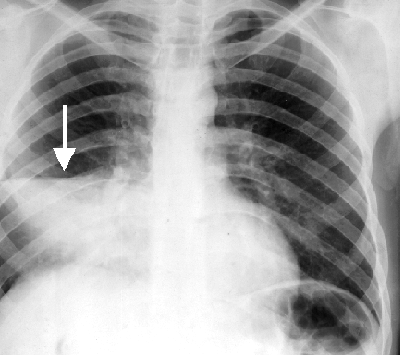 Крупозная пневмония - стадии и диагностика заболевания