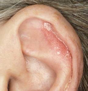 Почему шелушатся уши перхоть в ушах причины и лечение