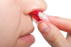Выделения в виде соплей при гайморите из носа: способы лечения