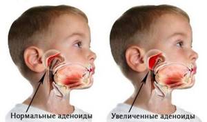 Рыхлые миндалины и горло у ребенка