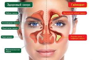 Выделения в виде соплей при гайморите из носа: способы лечения