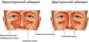 Болит скула и челюсть возле уха справа или слева больно жевать, отдает в ухо - лечение