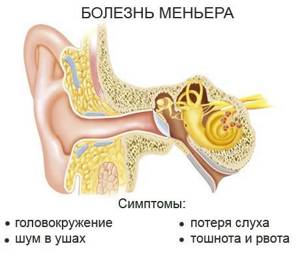 Гул в ушах – неспецифический симптом. Причины гула в ушах.