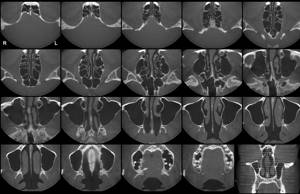 Компьютерная томография КТ околоносовых пазух и носа