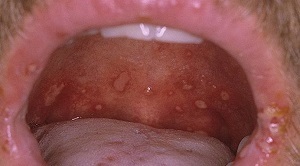 Ангина с язвами во рту - причины появления, диагностика и лечение