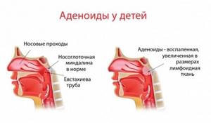 Жидкость в ухе за барабанной перепонкой: лечение