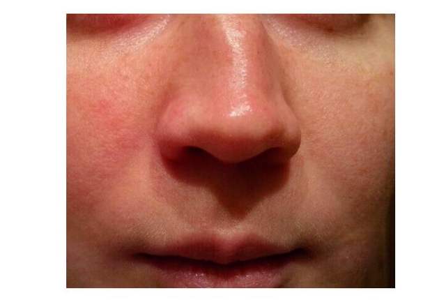 Выпрямление носовой перегородки - способы исправить дефект