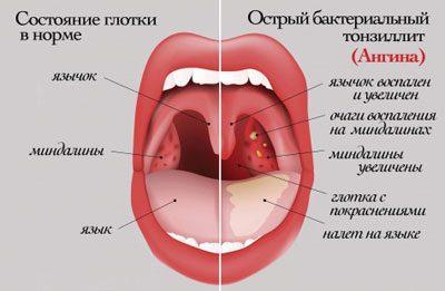 Мирамистин спрей инструкция по применению при боле в горле