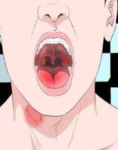 Как и чем лечить ожог горла и гортани: причины и симптомы