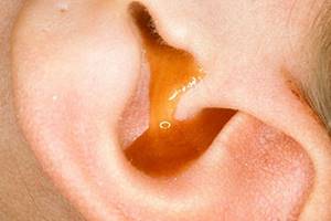 Из уха течет жидкость прозрачная, желтая - патология