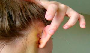 Реабилитация после отопластики сколько заживают уши, как проходит период