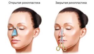 Крылья носа: лечение, разновидности пластики