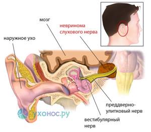 Невринома слухового нерва симптомы и лечение