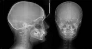 Рентген пазух носа при гайморите - описание патологии, проведение рентгена
