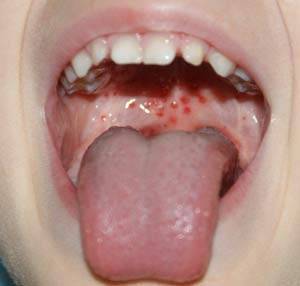 Волдыри на задней стенке горла: симптомы и как лечить заболевание