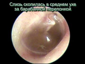 Шунтирование барабанной перепонки уха у детей и взрослых