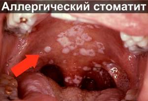 Хлорофиллипт при стоматите - как разводить для полоскания рта и десен
