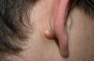 Атерома за ухом на мочке: диагностика, причины, симптомы и лечение