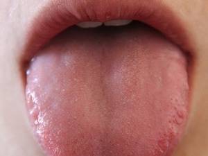 Как проявляются полипы на языке, ближе к горлу или под языком