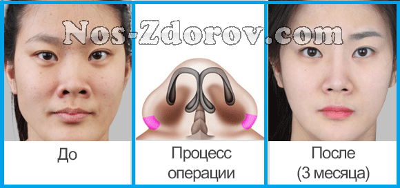 Крылья носа: лечение, разновидности пластики