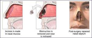 Искривление носовой перегородки причины, симптомы и лечение