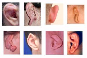 Мочка уха зачем нужна, объяснение генетиков, деформации ушей