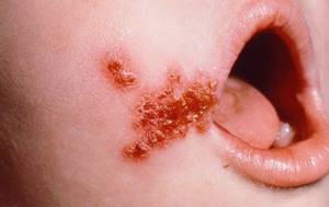Стрептококковая ангина у ребенка: симптомы и лечение