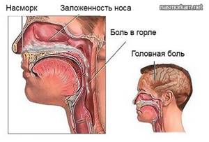 Откуда берутся сопли в носу у человека, возможное лечение