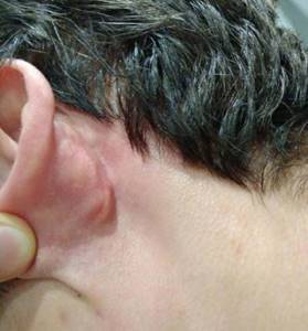 Появилась шишка за ухом: причины и лечение. Факторы риска.