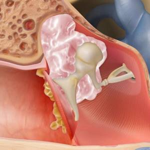 Холестеатома уха - причины, симптомы, диагностика и лечение