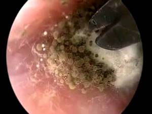 Лечение отомикоза уха. Симптомы, фото и диагностика ушного грибка