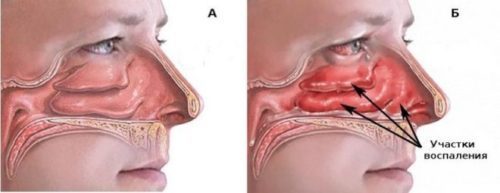 Гормональные капли в нос - наиболее популярные препараты