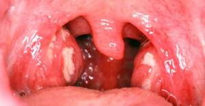 Язычок в горле - как называется и для чего он нужен, увулит симптомы и лечение