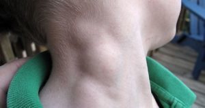 Воспаление лимфоузлов на шее - симптомы, причины, признаки, лечение