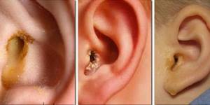Как убрать слизь из слухового канала: возможные варианты