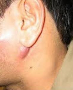 Лимфоузел под ухом воспалился причины, симптомы, лечение